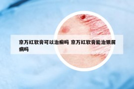 京萬(wàn)紅軟膏可以治癬嗎 京萬(wàn)紅軟膏能治銀屑病嗎