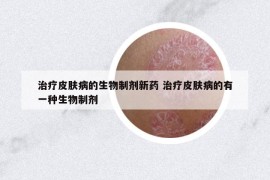 治療皮膚病的生物制劑新藥 治療皮膚病的有一種生物制劑