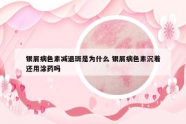 銀屑病色素減退斑是為什么 銀屑病色素沉著還用涂藥嗎