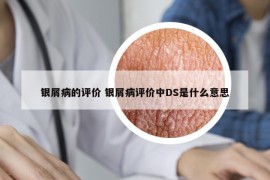 銀屑病的評價 銀屑病評價中DS是什么意思
