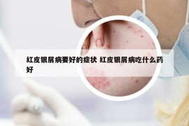 紅皮銀屑病要好的癥狀 紅皮銀屑病吃什么藥好