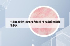 牛皮血癬會引起免疫力低嗎 牛皮血癬晚期能活多久