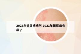 2023年銀屑病病例 2021年銀屑病有救了