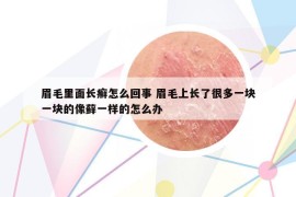 眉毛里面長(zhǎng)癬怎么回事 眉毛上長(zhǎng)了很多一塊一塊的像蘚一樣的怎么辦