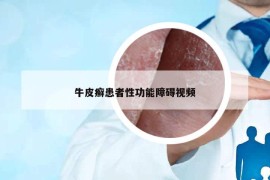 牛皮癬患者性功能障礙視頻