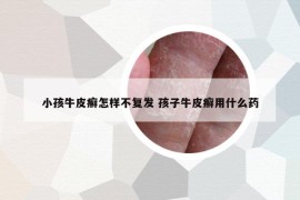 小孩牛皮癬怎樣不復(fù)發(fā) 孩子牛皮癬用什么藥