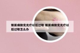 銀屑病做完光療以后過(guò)敏 銀屑病做完光療以后過(guò)敏怎么辦