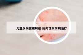 兒童反向性銀屑病 反向性銀屑病治療