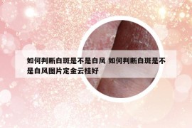 如何判斷白斑是不是白風(fēng) 如何判斷白斑是不是白風(fēng)圖片定金云桂好