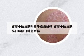 邯鄲中信皮膚科看牛皮癬好嗎 邯鄲中信皮膚科門診部口碑怎么樣
