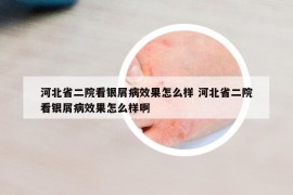 河北省二院看銀屑病效果怎么樣 河北省二院看銀屑病效果怎么樣啊