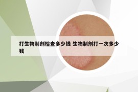 打生物制劑檢查多少錢(qián) 生物制劑打一次多少錢(qián)