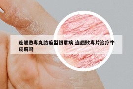 連翹敗毒丸膿皰型銀屑病 連翹敗毒片治療牛皮癬嗎
