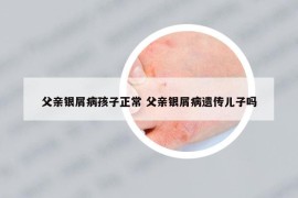父親銀屑病孩子正常 父親銀屑病遺傳兒子嗎