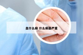 盤什么癬 什么癬最嚴(yán)重