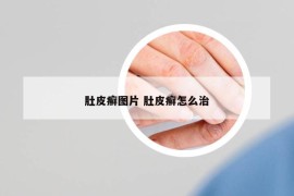 肚皮癬圖片 肚皮癬怎么治