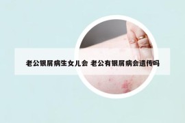 老公銀屑病生女兒會(huì) 老公有銀屑病會(huì)遺傳嗎