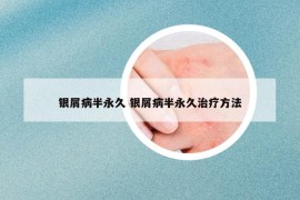 銀屑病半永久 銀屑病半永久治療方法