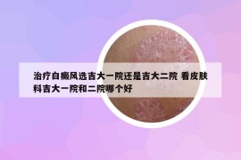治療白癜風(fēng)選吉大一院還是吉大二院 看皮膚科吉大一院和二院哪個好