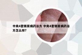 中央4套銀屑病藥浴方 中央4套銀屑病藥浴方怎么樣?