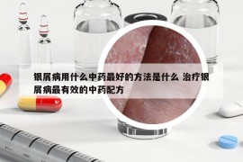 銀屑病用什么中藥最好的方法是什么 治療銀屑病最有效的中藥配方