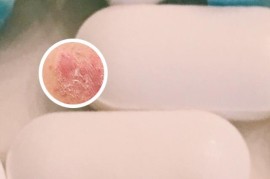 用了生物制劑可以管一輩子嗎