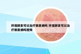 環(huán)保酵素可以治療銀屑病嗎 環(huán)保酵素可以治療銀屑病嗎視頻