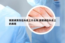 銀屑病發(fā)生在頭皮上什么樣 銀屑病在頭皮上的表現(xiàn)
