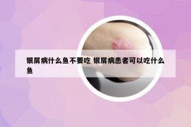 銀屑病什么魚不要吃 銀屑病患者可以吃什么魚