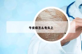 牛皮癬怎么龜頭上