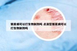 銀屑病可以打生物制劑嗎 點滴型銀屑病可以打生物制劑嗎