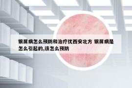 銀屑病怎么預(yù)防和治療優(yōu)西安北方 銀屑病是怎么引起的,該怎么預(yù)防