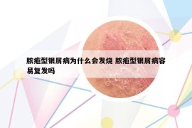 膿皰型銀屑病為什么會發(fā)燒 膿皰型銀屑病容易復(fù)發(fā)嗎