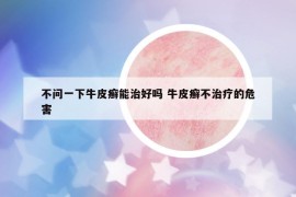 不問一下牛皮癬能治好嗎 牛皮癬不治療的危害