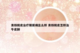 青核桃皮冶療銀屑病怠么樣 青核桃皮怎樣治牛皮鮮
