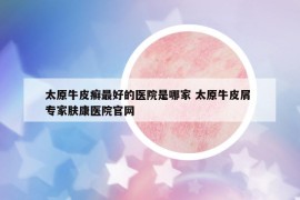 太原牛皮癬最好的醫(yī)院是哪家 太原牛皮屑 專(zhuān)家膚康醫(yī)院官網(wǎng)