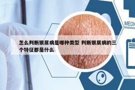 怎么判斷銀屑病是哪種類型 判斷銀屑病的三個(gè)特征都是什么