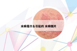 水癬是什么引起的 水癬圖片