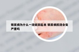 銀屑病為什么一撓就鼓起來 銀屑病抓撓會變嚴重嗎