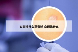 白斑擦什么藥膏好 白斑涂什么