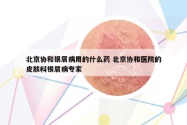 北京協(xié)和銀屑病用的什么藥 北京協(xié)和醫(yī)院的皮膚科銀屑病專家