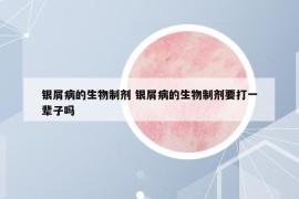 銀屑病的生物制劑 銀屑病的生物制劑要打一輩子嗎