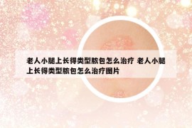 老人小腿上長得類型膿包怎么治療 老人小腿上長得類型膿包怎么治療圖片