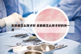 皮膚癬怎么樣才好 皮膚癬怎么樣才好的快一點(diǎn)