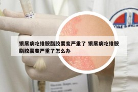銀屑病吃維胺脂膠囊變嚴(yán)重了 銀屑病吃維胺脂膠囊變嚴(yán)重了怎么辦