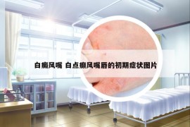 白癜風(fēng)嘴 白點(diǎn)癲風(fēng)嘴唇的初期癥狀圖片
