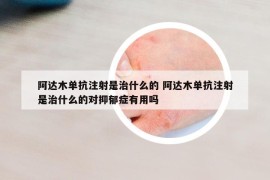 阿達(dá)木單抗注射是治什么的 阿達(dá)木單抗注射是治什么的對(duì)抑郁癥有用嗎