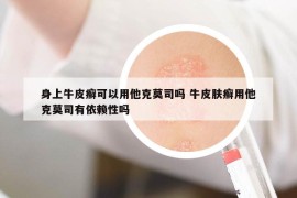 身上牛皮癬可以用他克莫司嗎 牛皮膚癬用他克莫司有依賴性嗎