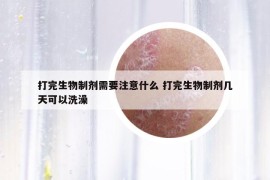 打完生物制劑需要注意什么 打完生物制劑幾天可以洗澡