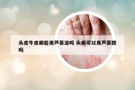 頭皮牛皮癬能用蘆薈涂嗎 頭癬可以用蘆薈膠嗎